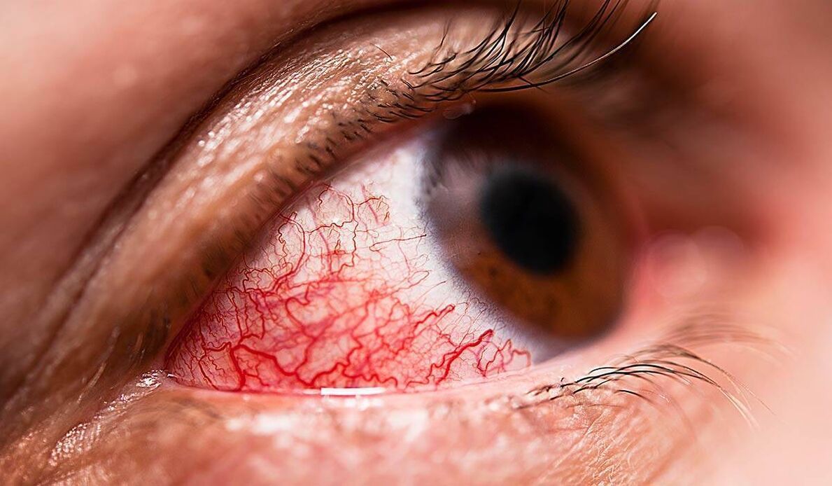 A retinopatía diabética é unha das complicacións tardías da diabetes